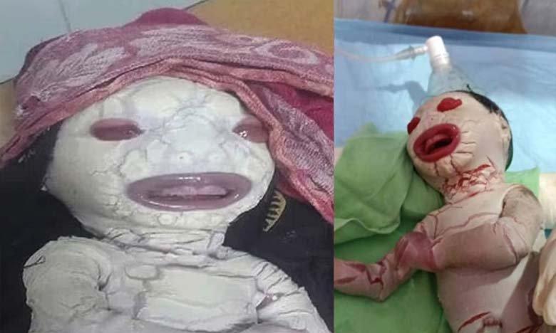 Alien-like Baby Born in Madhya Pradesh Struggling to Breathe Condition Critical